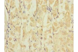 Immunohistochemistry of paraffin-embedded human gastric cancer using ABIN7153977 at dilution of 1:100 (GRIK3 antibody  (AA 32-240))