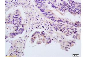 Formalin-fixed and paraffin embedded human rectal carcinoma labeled with Rabbit Anti ANGPTL1/Angiopoietin 1/ANG-1 Polyclonal Antibody, Unconjugated (ABIN728323) at 1:200 followed by conjugation to the secondary antibody and DAB staining (Angiopoietin 1 antibody  (AA 276-375))