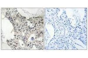 Immunohistochemistry analysis of paraffin-embedded human breast carcinoma tissue using BAGE4 antibody. (BAGE4 antibody)