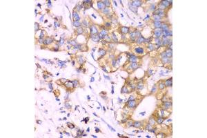 Immunohistochemistry of paraffin-embedded human liver cancer using RPS3A Antibody (ABIN5973489) at dilution of 1/100 (40x lens). (RPS3A antibody)