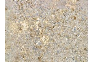 ABIN6262479 and ABIN6273001 at 1/100 staining human melanoma by IHC-P.