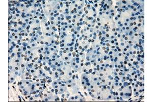 Immunohistochemical staining of paraffin-embedded Adenocarcinoma of colon tissue using anti-SATB1mouse monoclonal antibody. (SATB1 antibody)