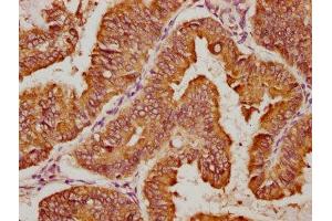 IHC image of ABIN7150537 diluted at 1:100 and staining in paraffin-embedded human endometrial cancer performed on a Leica BondTM system. (DNAJC1 antibody  (AA 521-793))