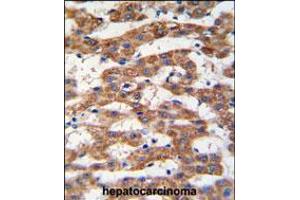 Formalin-fixed and paraffin-embedded human hepatocarcinoma tissue reacted with PHB antibody , which was peroxidase-conjugated to the secondary antibody, followed by DAB staining. (Prohibitin antibody  (AA 89-117))