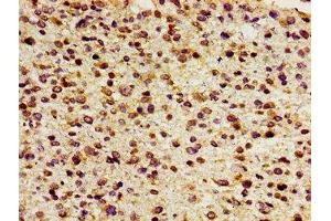 Immunohistochemistry of paraffin-embedded human glioma using ABIN7153030 at dilution of 1:100