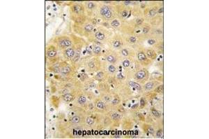 Formalin-fixed and paraffin-embedded human hepatocarcinoma tissue reacted with CTGF antibody (C-term) (ABIN392204 and ABIN2841904) , which was peroxidase-conjugated to the secondary antibody, followed by DAB staining. (CTGF antibody  (C-Term))