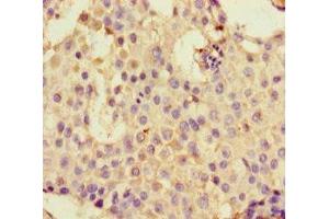 Immunohistochemistry of paraffin-embedded human breast cancer using ABIN7145002 at dilution of 1:100