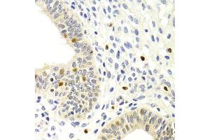 Immunohistochemistry of paraffin-embedded human metrocarcinoma using GEMIN2 antibody at dilution of 1:200 (400x lens). (SIP1 antibody)