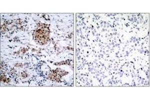 Immunohistochemistry analysis of paraffin-embedded human breast carcinoma, using Estrogen Receptor-alpha (Phospho-Ser167) Antibody. (Estrogen Receptor alpha antibody  (pSer167))
