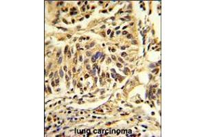 Formalin-fixed and paraffin-embedded human lung carcinoma reacted with CEBPB Antibody , which was peroxidase-conjugated to the secondary antibody, followed by DAB staining.