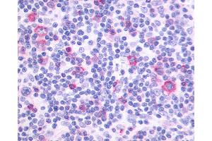 Anti-PTGIR / IP Receptor antibody IHC of human Lymph Node, Hodgkins Lymphoma. (Prostacyclin Receptor antibody  (N-Term))