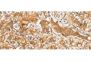 Immunohistochemistry of paraffin-embedded Human liver cancer tissue using RIDA Polyclonal Antibody at dilution of 1:65(x200) (HRSP12 antibody)