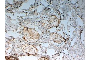 ABIN185029 (2 µg/mL) staining of paraffin embedded Human Breast cancer. (FOXC2 antibody  (C-Term))