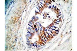 Human stomach cancer tissue was stained by rabbit Anti-Spexin prepro (73-116)  (H) Antiserum (Spexin antibody  (Preproprotein))