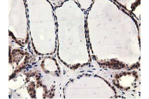 Immunohistochemical staining of paraffin-embedded Carcinoma of Human kidney tissue using anti-CBWD1 mouse monoclonal antibody. (CBWD1 antibody)