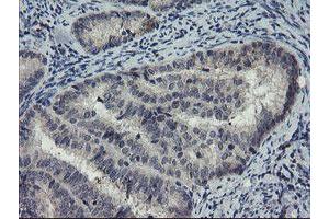 Immunohistochemical staining of paraffin-embedded Adenocarcinoma of Human endometrium tissue using anti-DOK7 mouse monoclonal antibody. (DOK7 antibody)