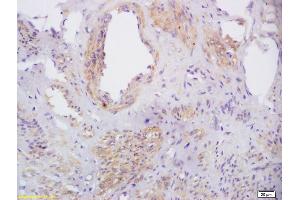 Formalin-fixed and paraffin embedded human cervical carcinoma labeled with Rabbit Anti phospho-CXCR4(Ser339) Polyclonal Antibody, Unconjugated (ABIN1714582) at 1:200 followed by conjugation to the secondary antibody and DAB staining (CXCR4 antibody  (pSer339))