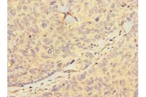 Immunohistochemistry of paraffin-embedded human ovarian cancer using ABIN7155399 at dilution of 1:100