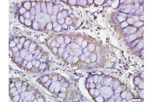 Paraformaldehyde-fixed, paraffin embedded human colon carcinoma, Antigen retrieval by boiling in sodium citrate buffer (pH6. (PDE7B antibody  (AA 281-360))