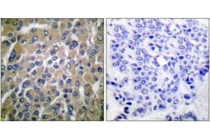 Immunohistochemistry analysis of paraffin-embedded human breast carcinoma tissue, using hCG beta Antibody. (HCG beta antibody  (AA 101-150))