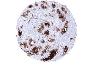 Squamous cell carcinoma showing strong KLK7 staining in areas of keratinization (Kallikrein 7 antibody)