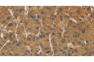 Immunohistochemistry of paraffin-embedded Human liver cancer tissue using CYP17A1 Polyclonal Antibody at dilution 1:30 (CYP17A1 antibody)