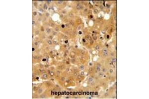 PRK Antibody (ABIN652306 and ABIN2841396) IHC analysis in formalin fixed and paraffin embedded human hepatocarcinoma followed by peroxidase conjugation of the secondary antibody and DAB staining.