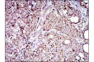Immunohistochemical analysis of paraffin-embedded cervical cancer tissues using ALDH2 mouse mAb with DAB staining. (ALDH2 antibody  (AA 317-517))