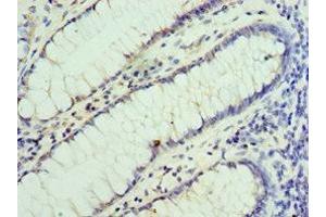 Immunohistochemistry of paraffin-embedded human colon cancer using ABIN7155860 at dilution of 1:100 (VENTX antibody  (AA 1-258))