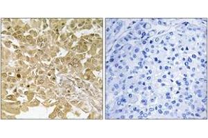 Immunohistochemistry analysis of paraffin-embedded human breast carcinoma tissue, using MEK1 (Ab-291) Antibody. (MEK1 antibody  (AA 261-310))