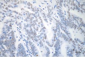 Immunohistochemistry was performed on paraffin-embedded human endometrial carcinoma using TP53BP1 antibody (ABIN7800690), 1:(ABIN7798691). (TP53BP1 antibody)