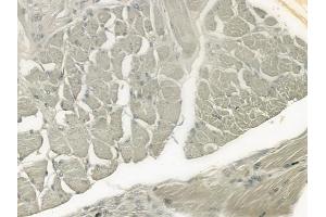 ABIN6261262 and ABIN6276488 at 1/100 staining human tongue carcinoma by IHC-P. (DEFB132 antibody  (Internal Region))