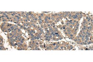 Immunohistochemistry of paraffin-embedded Human liver cancer tissue using CORO1B Polyclonal Antibody at dilution of 1:40(x200) (CORO1B antibody)