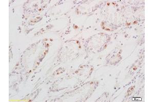 Formalin-fixed and paraffin embedded human gastric carcinoma labeled with Anti-TGF alpha Polyclonal Antibody, Unconjugated (ABIN724415) at 1:200 followed by conjugation to the secondary antibody and DAB staining