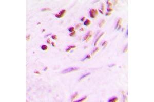 Immunohistochemical analysis of MYF5 staining in human lung cancer formalin fixed paraffin embedded tissue section. (MYF5 antibody  (Center))