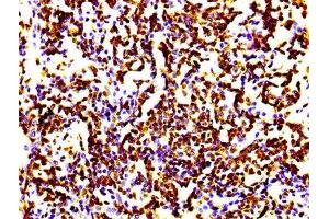 IHC image of ABIN7127297 diluted at 1:100 and staining in paraffin-embedded human lung cancer performed on a Leica BondTM system. (Recombinant HIST1H4A antibody)