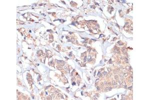Immunohistochemistry of paraffin-embedded Human breast cancer using PRMT7 Polyclonal Antibody at dilution of 1:200 (40x lens). (PRMT7 antibody)