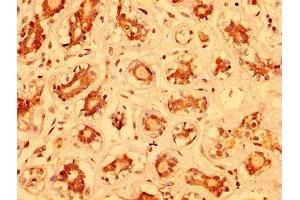 IHC image of ABIN7160478 diluted at 1:400 and staining in paraffin-embedded human breast cancer performed on a Leica BondTM system. (MZF1 antibody  (AA 186-354))