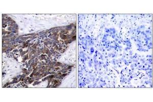 Immunohistochemical analysis of paraffin-embedded human breast carcinoma tissue using Connexin43 (phospho-Ser367) antibody (E011258). (Connexin 43/GJA1 antibody  (pSer367))