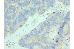 Immunohistochemistry of paraffin-embedded human colon cancer using ABIN7152098 at dilution of 1:100 (Elf4 antibody  (AA 1-200))