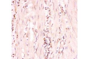 IHC-P: MRP4 antibody testing of human intestinal cancer tissue (ABCC4 antibody  (AA 1-370))