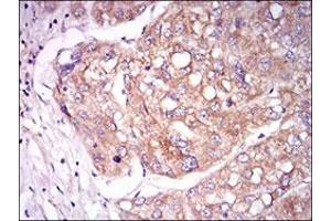 Immunohistochemical staining of human liver cancer tissues with TIE1 monoclonal antibody, clone 8D12B10  at 1:200-1:1000 dilution. (TIE1 antibody  (AA 385-607))
