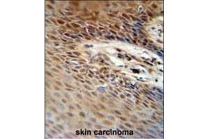 ZNF324B antibody (C-term) (ABIN654564 and ABIN2844270) immunohistochemistry analysis in formalin fixed and paraffin embedded human skin carcinoma followed by peroxidase conjugation of the secondary antibody and DAB staining. (ZNF324B antibody  (C-Term))