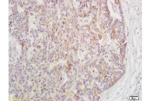 Formalin-fixed and paraffin embedded human rectal carcinoma labeled with Rabbit Anti-Phospho-TAK1(Ser192) Polyclonal Antibody, Unconjugated (ABIN802023) at 1:200 followed by conjugation to the secondary antibody and DAB staining (TR4 antibody  (pSer192))