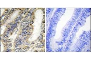 Immunohistochemistry analysis of paraffin-embedded human colon carcinoma tissue, using TNFA Antibody. (TNF alpha antibody  (AA 141-190))