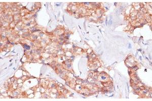 Immunohistochemistry of paraffin-embedded Human breast cancer using TIMM8B Polyclonal Antibody at dilution of 1:100 (40x lens). (TIMM8B antibody)