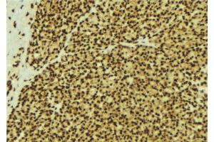 ABIN6269300 at 1/100 staining Human breast cancer tissue by IHC-P.