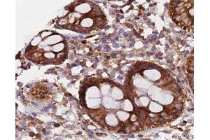 ABIN6266573 at 1/200 staining human colon carcinoma tissue sections by IHC-P. (KRT20 antibody  (C-Term))