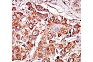 IHC analysis of FFPE human hepatocarcinoma stained with the PKR antibody (EIF2AK2 antibody  (AA 11-42))