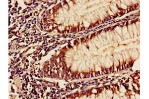 Immunohistochemistry of paraffin-embedded human colon cancer using ABIN7175954 at dilution of 1:100 (YAF2 antibody  (AA 1-204))